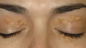 2 dấu hiệu trên mặt cảnh báo cholesterol xấu chạm ngưỡng nguy hiểm