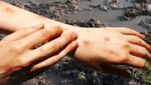 Cảnh giác 'sốt đất' - căn bệnh xuất hiện từ bùn đất