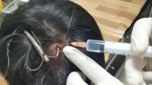 Móc câu 3 tiêu găm vào đầu khi câu cá, thiếu niên 15 tuổi nhập viện