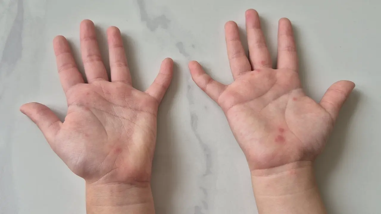 Sai lầm tước đi 'giờ vàng' cứu trẻ tay chân miệng.