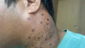 Tưởng cảm xoàng hóa ung thư giai đoạn cuối